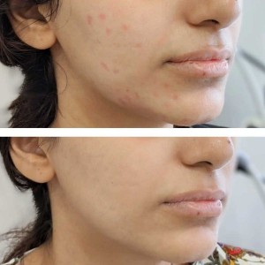 Scars and Pits Treatment in Gurgaon