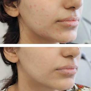 Scars and Pits Treatment in Delhi