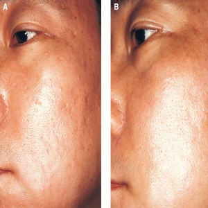 Scars and Pits Treatment in Civil Lines