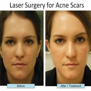 Scars and Pits Treatment in India