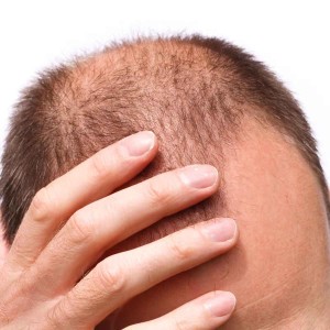 Stem Cell Therapy for Hair Growth and Stop Hair Fall in Patel Nagar