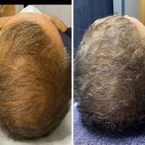 Stem Cell Therapy for Hair Growth and Stop Hair Fall in Laxmi Nagar