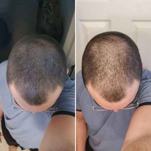 Stem Cell Therapy for Hair Growth and Stop Hair Fall in Delhi