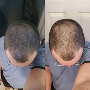 Stem Cell Therapy for Hair Growth and Stop Hair Fall in Lajpat Nagar