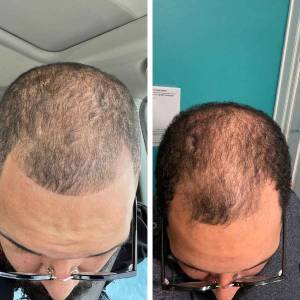 Stem Cell Therapy for Hair Growth and Stop Hair Fall in Paschim Vihar