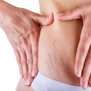 Stretch Marks Control Treatments in Rajasthan