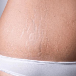 Stretch Marks Control Treatments in Jaipur