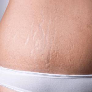 Stretch Marks Control Treatments in Delhi