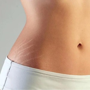 Stretch Marks Control Treatments in Connaught Place