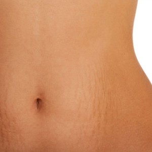 Stretch Marks Control Treatments in Agra