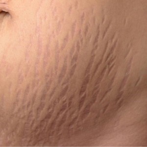 Stretch Marks Control Treatments in India