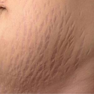 Stretch Marks Control Treatments in Laxmi Nagar