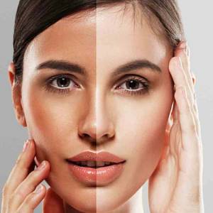 Tan Removal in Laxmi Nagar