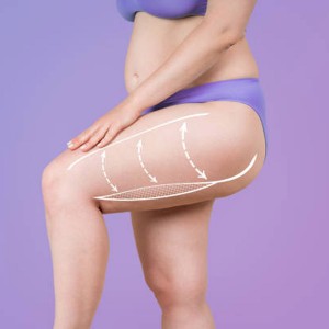 Thigh Lift in Civil Lines