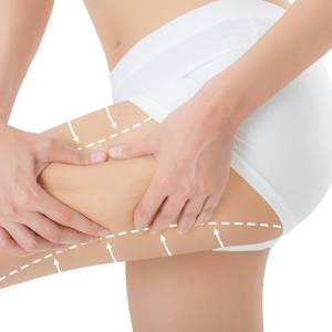 Thigh Lift in Yamuna Vihar