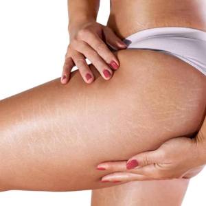 Thigh Lift in Greater Kailash