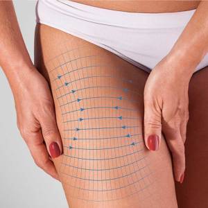 Thigh Lift in Yamuna Vihar