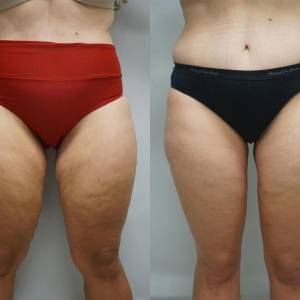 Thigh Tuck in Vasant Vihar