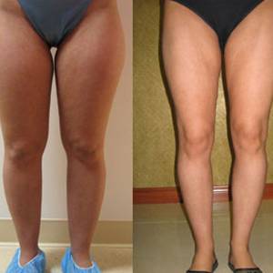 Thigh Tuck in Malviya Nagar