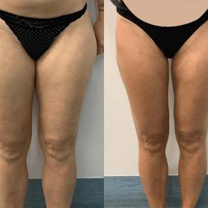 Thigh Tuck in Sarojini Nagar