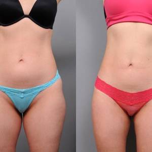 Thigh Tuck in Vasant Vihar