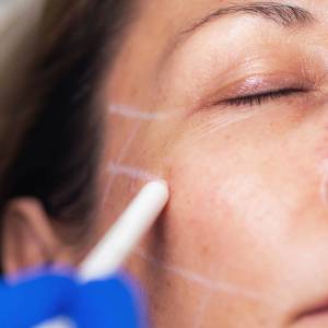 Threads For Skin Tightning in Lajpat Nagar