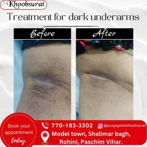 Treatment For Dark Underarms in Shalimar Bagh