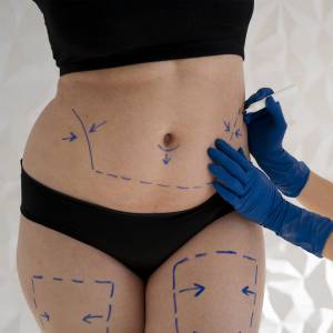 Tucks Therapy in Delhi