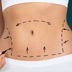 Tummy Tuck in Connaught Place