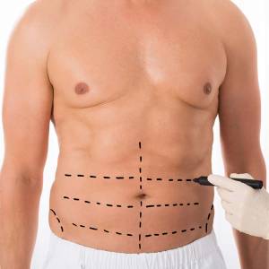 Tummy Tuck in Narela