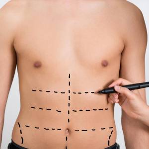 Tummy Tuck in Defence Colony